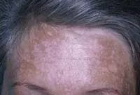 melasma