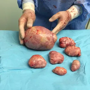 Sezaryen sırasında çıkardığımız en büyüğü 15 cm olan miyomlar