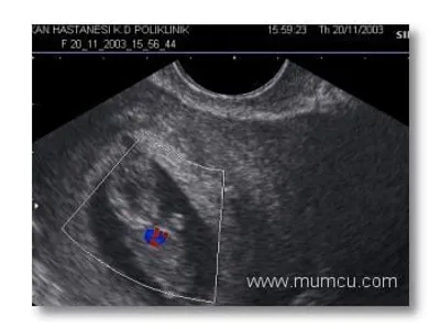 Fetal kafa ölçümünün normal değerleri